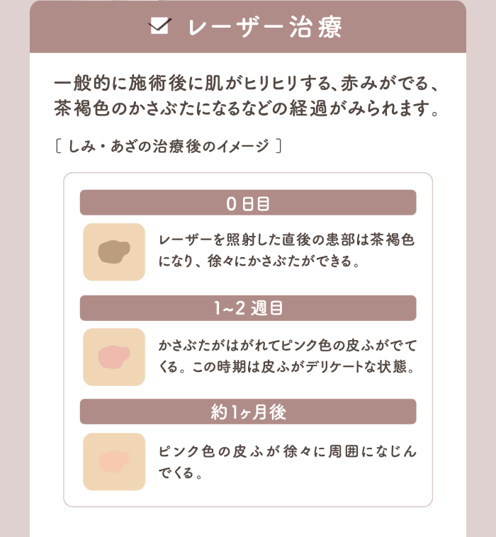 レーザー治療 一般的に施術後に肌がヒリヒリする、赤みがでる、茶褐色のかさぶたになるなどの経過がみられます。［しみ・あざの治療後のイメージ］ 0日目レーザーを照射した直後の患部は茶褐色になり、徐々にかさぶたができる。 1~2週目かさぶたがはがれてピンク色の皮ふがでてくる。この時期は皮ふがデリケートな状態。 約１ヶ月後ピンク色の皮ふが徐々に周囲になじんでくる。