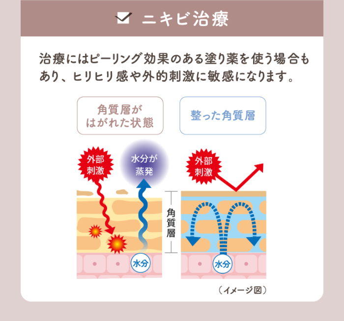 ニキビ治療 治療にはピーリング効果のある塗り薬を使う場合もあり、ヒリヒリ感や外的刺激に敏感になります。