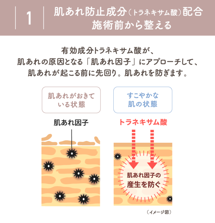 1 肌あれ防止成分（トラネキサム酸）配合 施術前から整える 有効成分トラネキサム酸が、肌あれの原因となる「肌あれ因子」にアプローチして、肌あれが起こる前に先回り。肌あれを防ぎます。