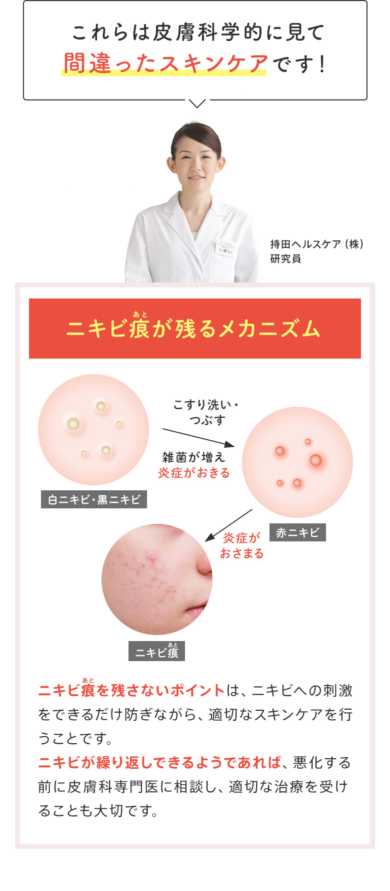これらは皮膚科学的に見て間違ったスキンケアです！ニキビ痕が残るメカニズム